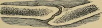 An illustration from Atlas and epitome of traumatic fractures and dislocations / by H. Helferich ; auth. tr. from the German, ed. by Joseph C. Bloodgood. (1902)