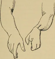 An illustration from Atlas and epitome of traumatic fractures and dislocations / by H. Helferich ; auth. tr. from the German, ed. by Joseph C. Bloodgood. (1902)