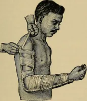 An illustration from Atlas and epitome of traumatic fractures and dislocations / by H. Helferich ; auth. tr. from the German, ed. by Joseph C. Bloodgood. (1902)