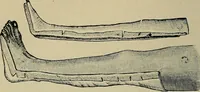 An illustration from Atlas and epitome of traumatic fractures and dislocations / by H. Helferich ; auth. tr. from the German, ed. by Joseph C. Bloodgood. (1902)