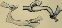 Picture 10 of 91 from Atlas and epitome of traumatic fractures and dislocations / by H. Helferich ; auth. tr. from the German, ed. by Joseph C. Bloodgood. (1902), leaf 92