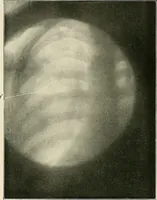 An illustration from Surgery of the lung / by C. Garrè and H. Quincke. (1913)