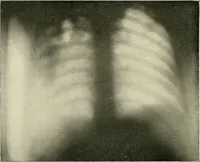 Picture 38 of 72 from Surgery of the lung / by C. Garrè and H. Quincke. (1913), leaf 116