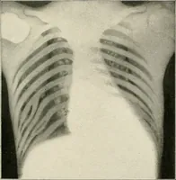 Picture 39 of 72 from Surgery of the lung / by C. Garrè and H. Quincke. (1913), leaf 143