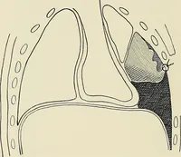 An illustration from Surgery of the lung / by C. Garrè and H. Quincke. (1913)