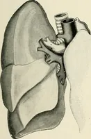 Picture 40 of 72 from Surgery of the lung / by C. Garrè and H. Quincke. (1913), leaf 145