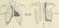 An illustration from Surgery of the lung / by C. Garrè and H. Quincke. (1913)