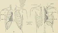 An illustration from Surgery of the lung / by C. Garrè and H. Quincke. (1913)