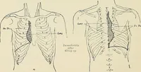 An illustration from Surgery of the lung / by C. Garrè and H. Quincke. (1913)