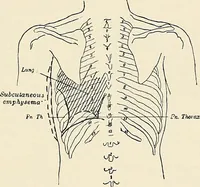 An illustration from Surgery of the lung / by C. Garrè and H. Quincke. (1913)