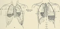 Picture 47 of 72 from Surgery of the lung / by C. Garrè and H. Quincke. (1913), leaf 163