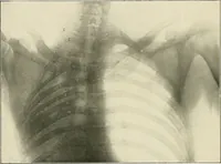 Picture 51 of 72 from Surgery of the lung / by C. Garrè and H. Quincke. (1913), leaf 186