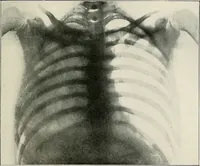 Picture 57 of 72 from Surgery of the lung / by C. Garrè and H. Quincke. (1913), leaf 199