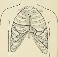 An illustration from Surgery of the lung / by C. Garrè and H. Quincke. (1913)
