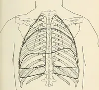 An illustration from Surgery of the lung / by C. Garrè and H. Quincke. (1913)