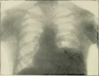 Picture 59 of 72 from Surgery of the lung / by C. Garrè and H. Quincke. (1913), leaf 216