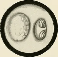 An illustration from Surgery of the lung / by C. Garrè and H. Quincke. (1913)
