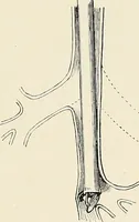 An illustration from Surgery of the lung / by C. Garrè and H. Quincke. (1913)