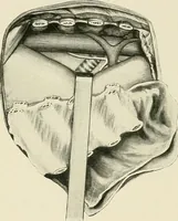 Picture 63 of 72 from Surgery of the lung / by C. Garrè and H. Quincke. (1913), leaf 246