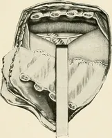 An illustration from Surgery of the lung / by C. Garrè and H. Quincke. (1913)