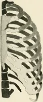 An illustration from Surgery of the lung / by C. Garrè and H. Quincke. (1913)
