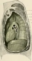 Picture 4 of 72 from Surgery of the lung / by C. Garrè and H. Quincke. (1913), leaf 31