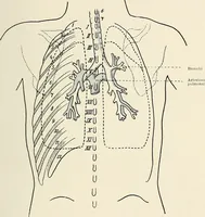 An illustration from Surgery of the lung / by C. Garrè and H. Quincke. (1913)