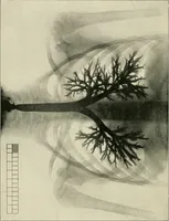 Picture 6 of 72 from Surgery of the lung / by C. Garrè and H. Quincke. (1913), leaf 36