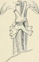 An illustration from Surgery of the lung / by C. Garrè and H. Quincke. (1913)