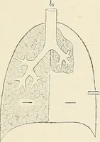 An illustration from Surgery of the lung / by C. Garrè and H. Quincke. (1913)