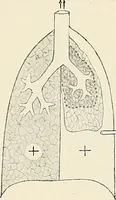 Picture 9 of 72 from Surgery of the lung / by C. Garrè and H. Quincke. (1913), leaf 39