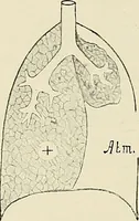 Picture 11 of 72 from Surgery of the lung / by C. Garrè and H. Quincke. (1913), leaf 40