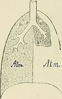 An illustration from Surgery of the lung / by C. Garrè and H. Quincke. (1913)
