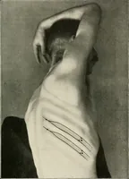An illustration from Surgery of the lung / by C. Garrè and H. Quincke. (1913)