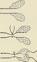 An illustration from Surgery of the lung / by C. Garrè and H. Quincke. (1913)
