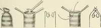 An illustration from Surgery of the lung / by C. Garrè and H. Quincke. (1913)