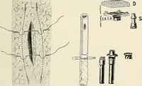 Picture 34 of 72 from Surgery of the lung / by C. Garrè and H. Quincke. (1913), leaf 85