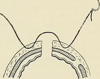 An illustration from Surgery of the lung / by C. Garrè and H. Quincke. (1913)
