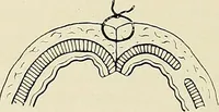 An illustration from Surgery of the lung / by C. Garrè and H. Quincke. (1913)