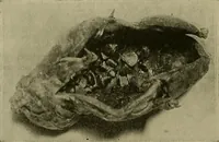 An illustration from Modern surgery, general and operative / by John Chalmers DaCosta. (1914)
