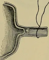 An illustration from Modern surgery, general and operative / by John Chalmers DaCosta. (1914)