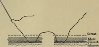 An illustration from Modern surgery, general and operative / by John Chalmers DaCosta. (1914)