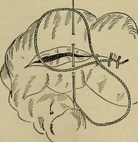 An illustration from Modern surgery, general and operative / by John Chalmers DaCosta. (1914)