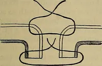 An illustration from Modern surgery, general and operative / by John Chalmers DaCosta. (1914)