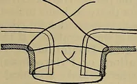 An illustration from Modern surgery, general and operative / by John Chalmers DaCosta. (1914)