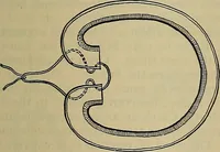 An illustration from Modern surgery, general and operative / by John Chalmers DaCosta. (1914)