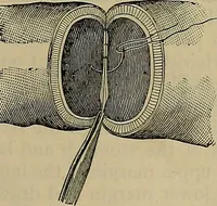 An illustration from Modern surgery, general and operative / by John Chalmers DaCosta. (1914)