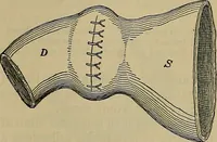 An illustration from Modern surgery, general and operative / by John Chalmers DaCosta. (1914)