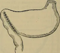 An illustration from Modern surgery, general and operative / by John Chalmers DaCosta. (1914)