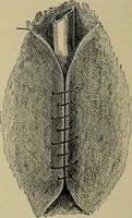 An illustration from Modern surgery, general and operative / by John Chalmers DaCosta. (1914)